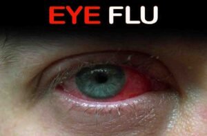 Read more about the article Conjunctivitis (Eye Flu)