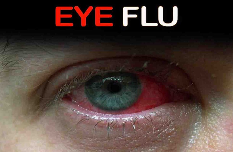 Conjunctivitis (Eye Flu)